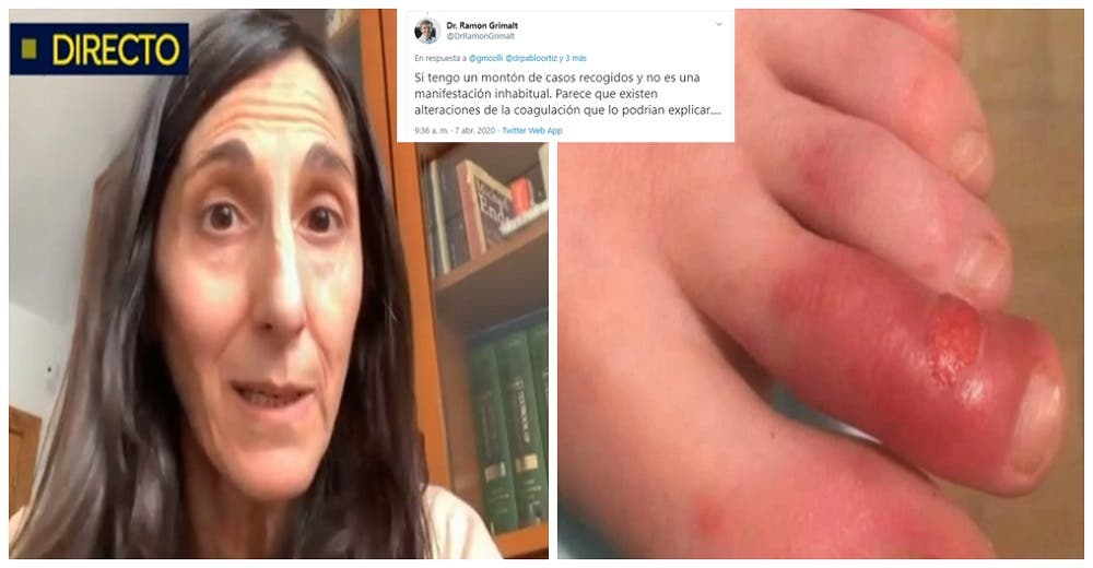 Dermatólogos advierten de afecciones en extremidades halladas en niños asintomáticos de COVID-19 Dermatólogos advierten de afecciones en extremidades halladas en niños asintomáticos de COVID-19