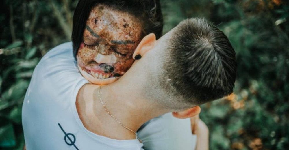 Habla la joven que pensó que jamás encontraría el amor por la apariencia de su rostro Habla la joven que pensó que jamás encontraría el amor por la apariencia de su rostro