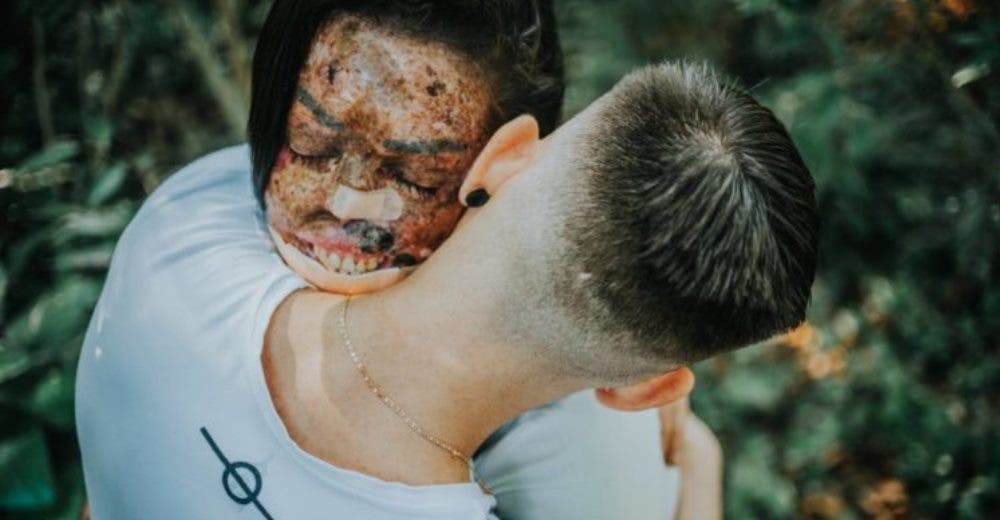 Habla la joven que pensó que jamás encontraría el amor por la apariencia de su rostro