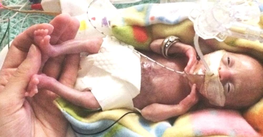 «Le supliqué al médico que lo intentara» – Su bebé se convirtió en la más prematura del mundo «Le supliqué al médico que lo intentara» – Su bebé se convirtió en la más prematura del mundo