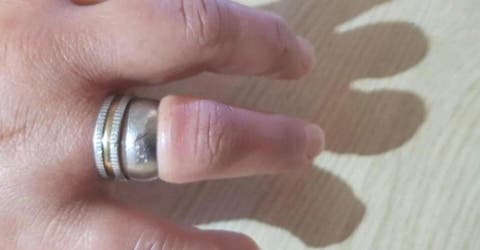 Intentan quitar el anillo atorado en su dedo con diversas herramientas durante horas