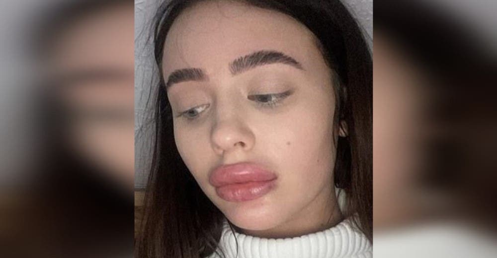 El drama de la joven que se sometió a un tratamiento fallido para inyectarse los labios