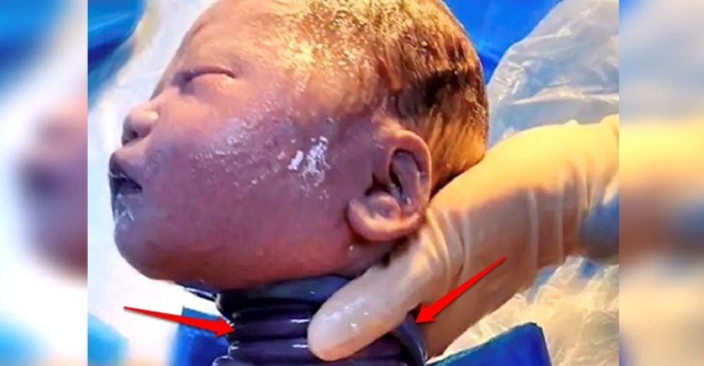El cordón de un bebé daba 6 vueltas alrededor de su cuello y hacen un parto natural El cordón de un bebé daba 6 vueltas alrededor de su cuello y hacen un parto natural