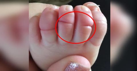 Difunde una foto del pie de su bebé para crear consciencia sobre un peligroso síndrome