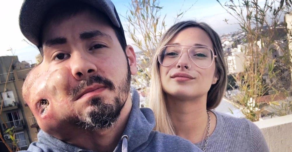 El joven con «dos caras» suplica ayuda en las redes a los médicos y encuentra al amor de su vida