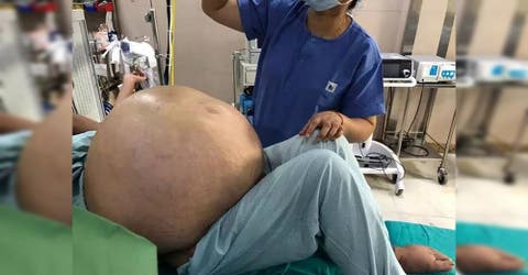 «Es un milagro que se haya salvado» – Le extraen a una mujer un tumor ovárico de 50 kilos
