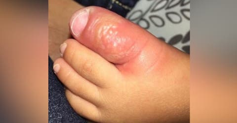 «Nadie debería besar a los bebés» – Muestra las graves lesiones en el dedo del pie de su hijo