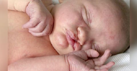 Adoptan al bebé con hidrocefalia y labio leporino del que sus padres no quisieron hacerse cargo