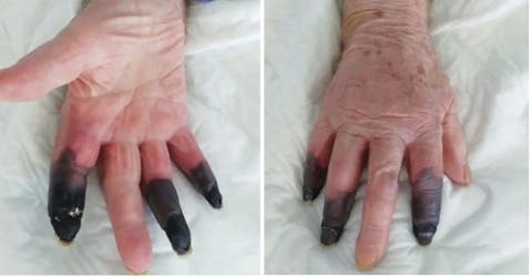 Le amputan 3 dedos por una grave consecuencia del COVID-19 – «Se volvieron totalmente negros»