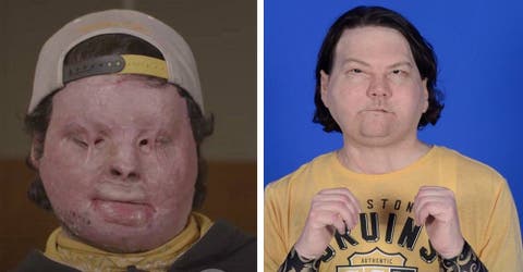 Es el primer paciente en el mundo que recibe con éxito un trasplante de cara y manos