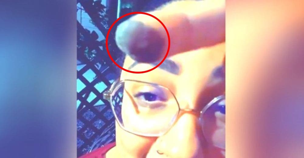 Muestra el color oscuro y los vellos de su dedo después de recibir un injerto de piel Muestra el color oscuro y los vellos de su dedo después de recibir un injerto de piel