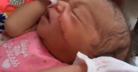 A una bebé le cortan la cara durante la cesárea y le cosen 13 puntos