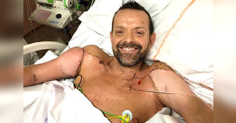 Es el primer hombre del mundo en recibir un trasplante de brazos  – «Desperté 3 meses después»