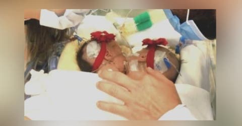 Se aferra a la esperanza de que sus 2 bebés que comparten 1 corazón sí sobrevivirán