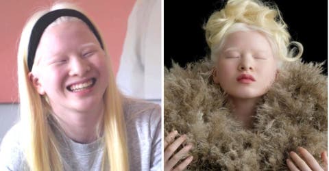 La niña dejada en un orfanato por su albinismo se convierte en una cotizada modelo