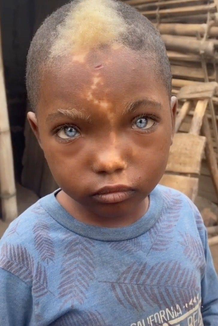 Niño africano cautiva por sus hermosos ojos azules y su marca en forma
