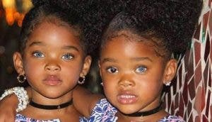 Famosas gemelas que todos regresaban a ver por sus extraños ojos, ya cumplieron 11 años