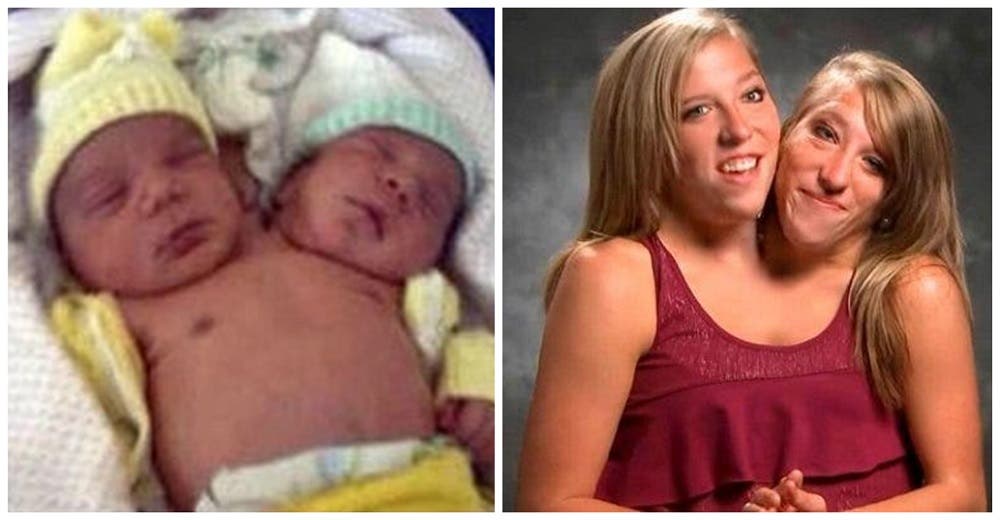 Las gemelas siamesas Abby y Brittany Hensel ya cumplieron 33 años, son un ejemplo de vida